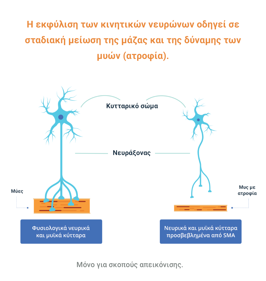 Κατανοηση της αιτιολογιας της νωτιαιας μυϊκης ατροφιας
